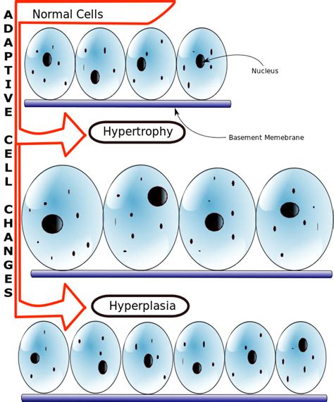 hiperplazie aldosteronoma vs adenoame